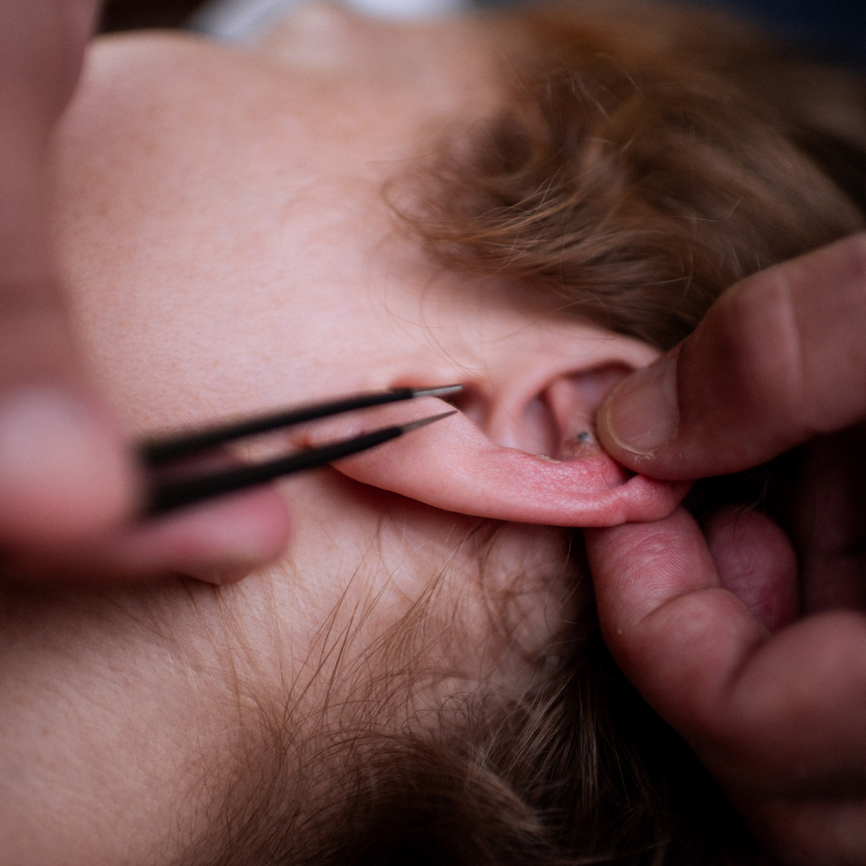 Ohrreflexzonentherapie mit Vaccaria-Samen